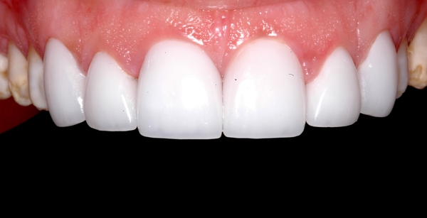 Porcelain Veneers in Scottsdale